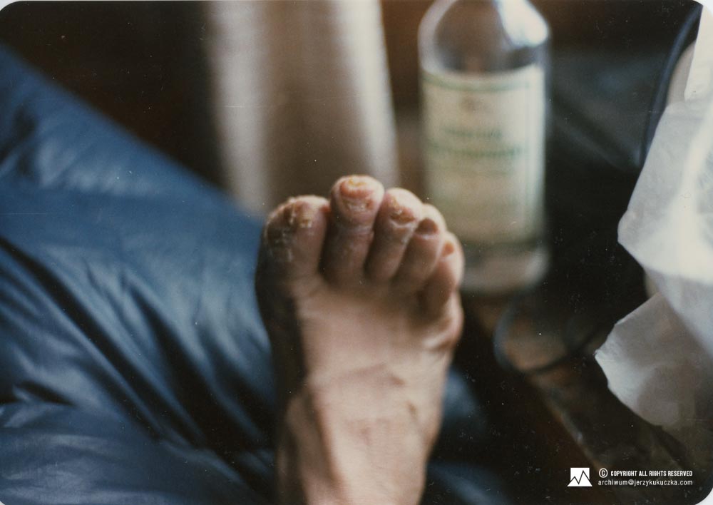 Stopa Jerzego Kukuczki po zejściu z Cho-Oyu. Fotografia przedstawia stan stopy Jerzego Kukuczki po zejściu z Cho-Oyu
